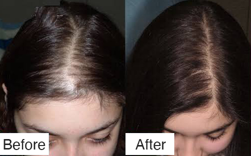 Before After Alopecia Woman