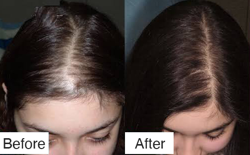MEN AND WOMEN ANDROGENIC ALOPECIA INNOAESTHETICS