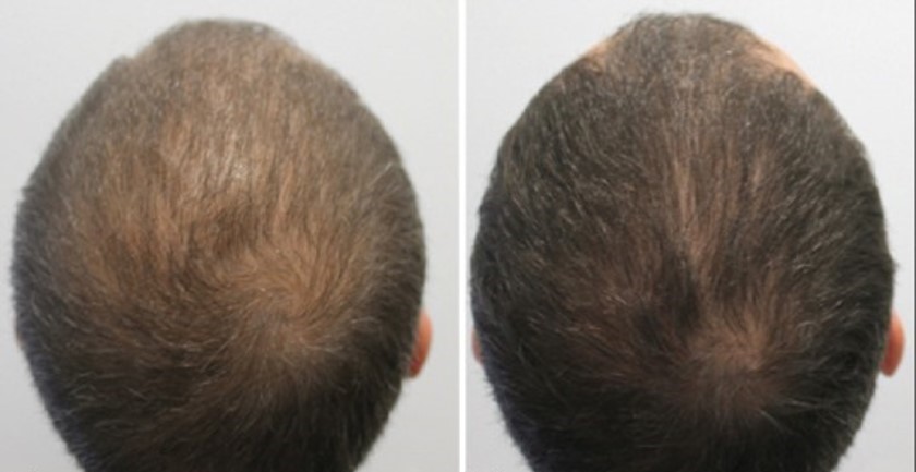 Before After Alopecia Man