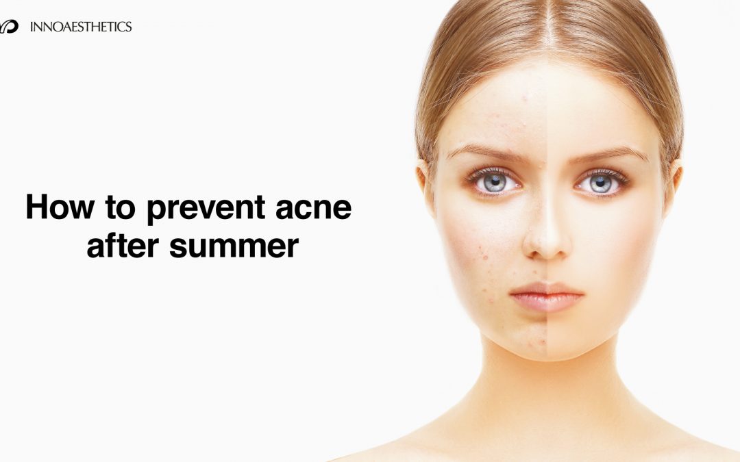 HOW TO PREVENT ACNE AFTER SUMMER