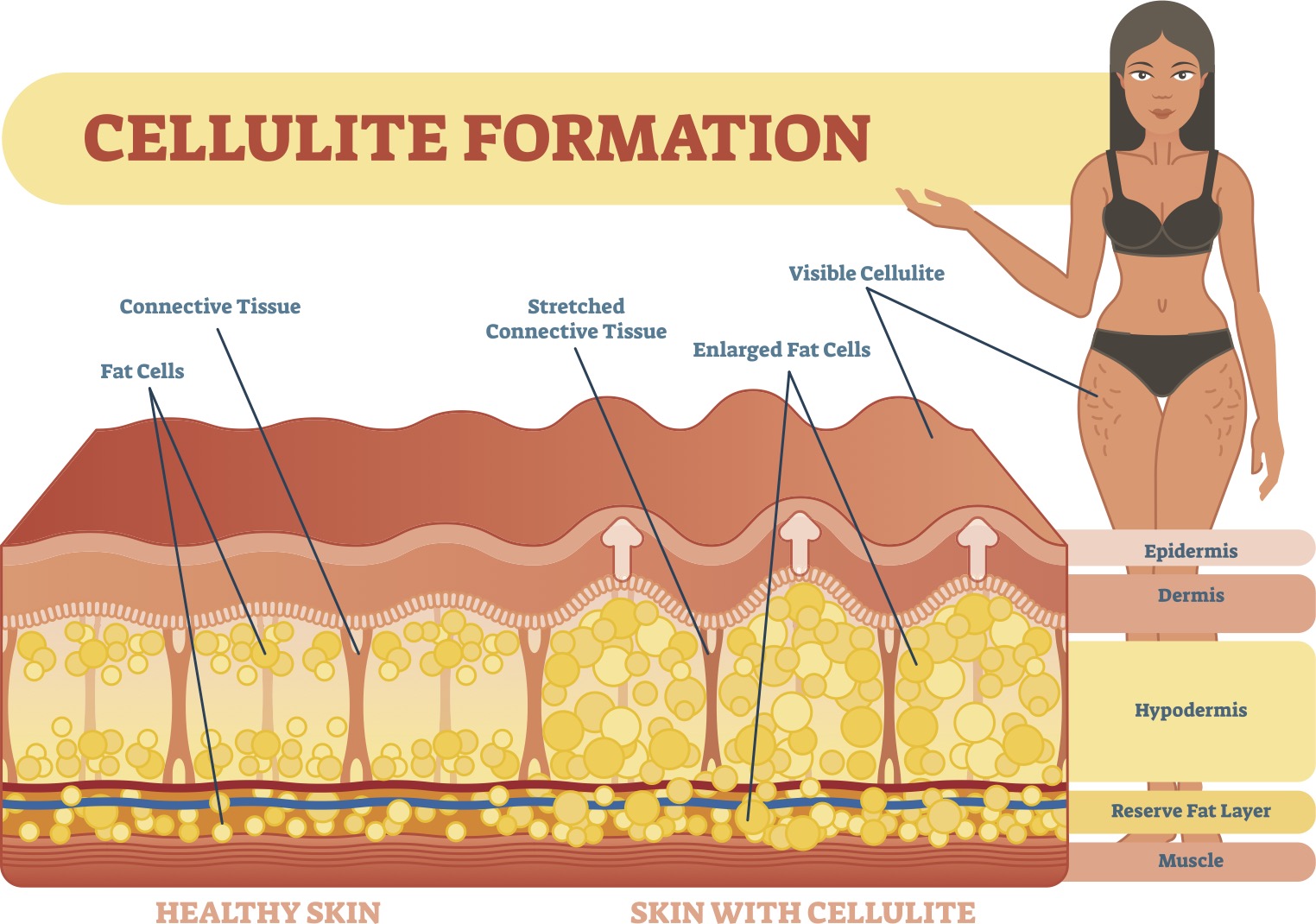 formación celulitis