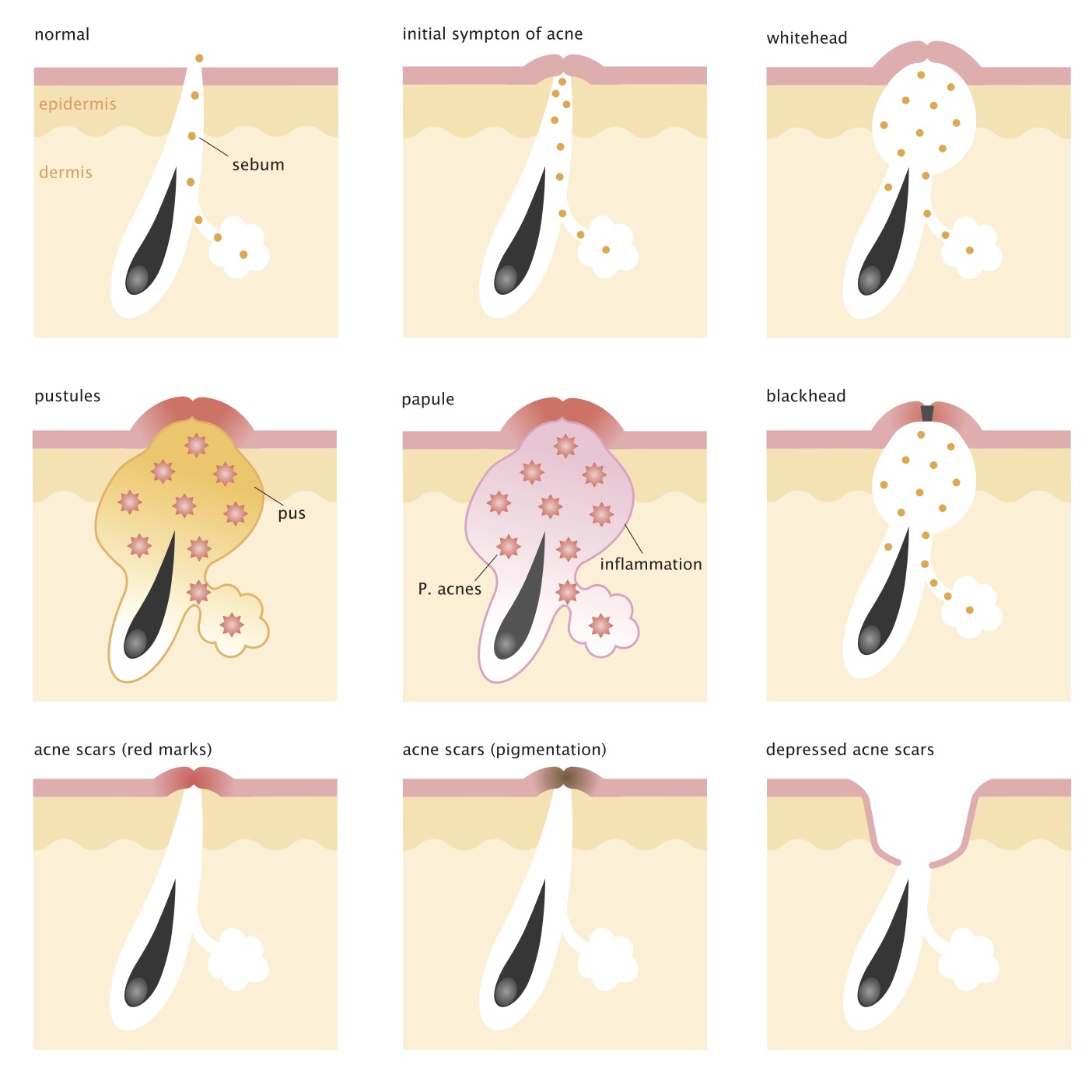 ACNE STAGES AND PIMPLE FORMATION