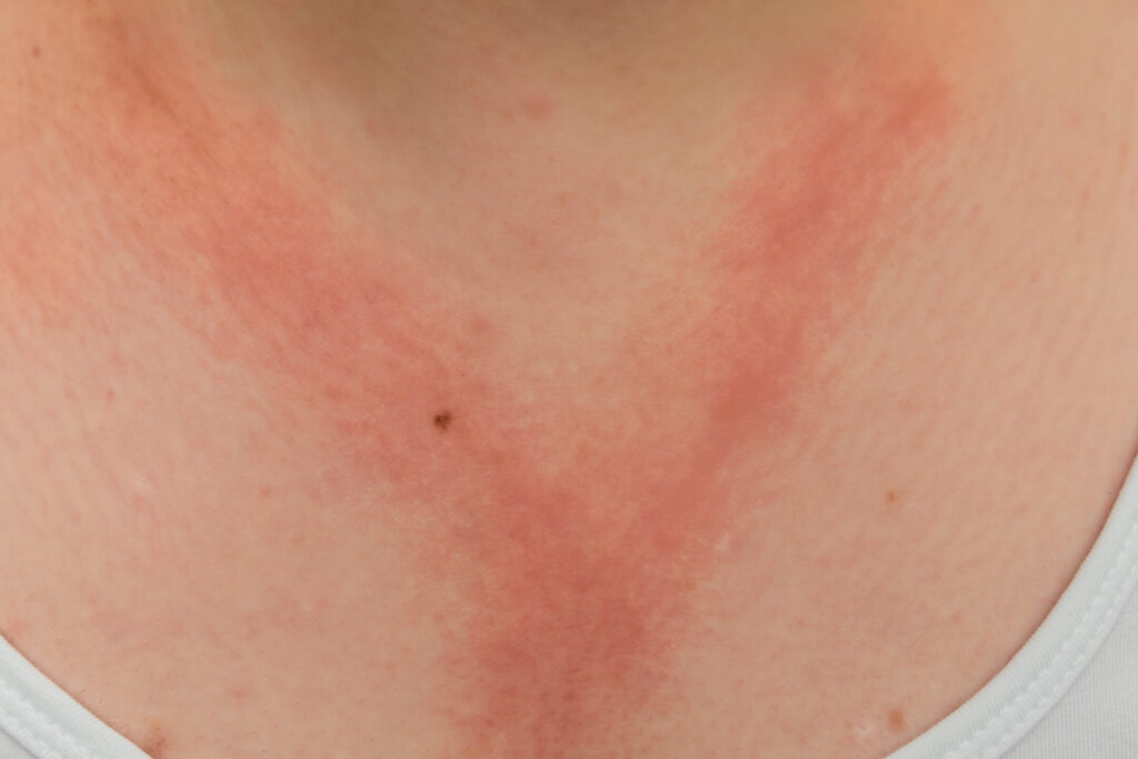 woman with eczema