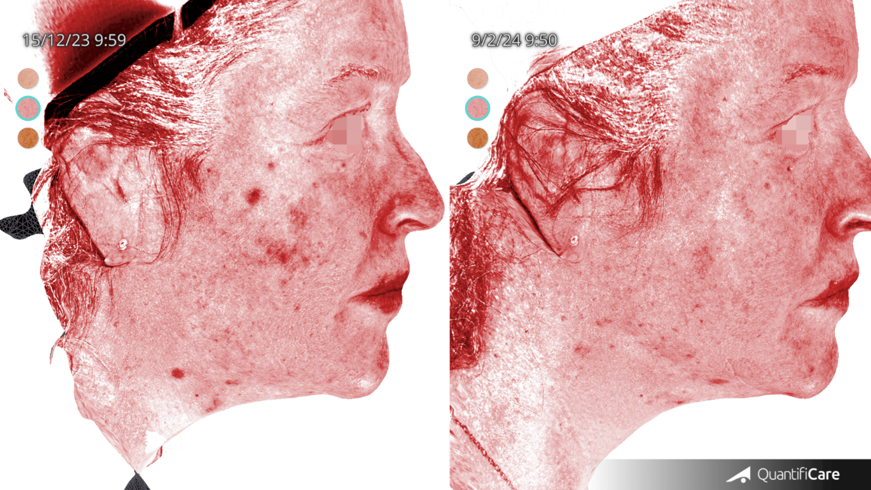 Resultado antes y después con INNO-EXOMA EXO-SKIN - Paciente 1, imagen 2