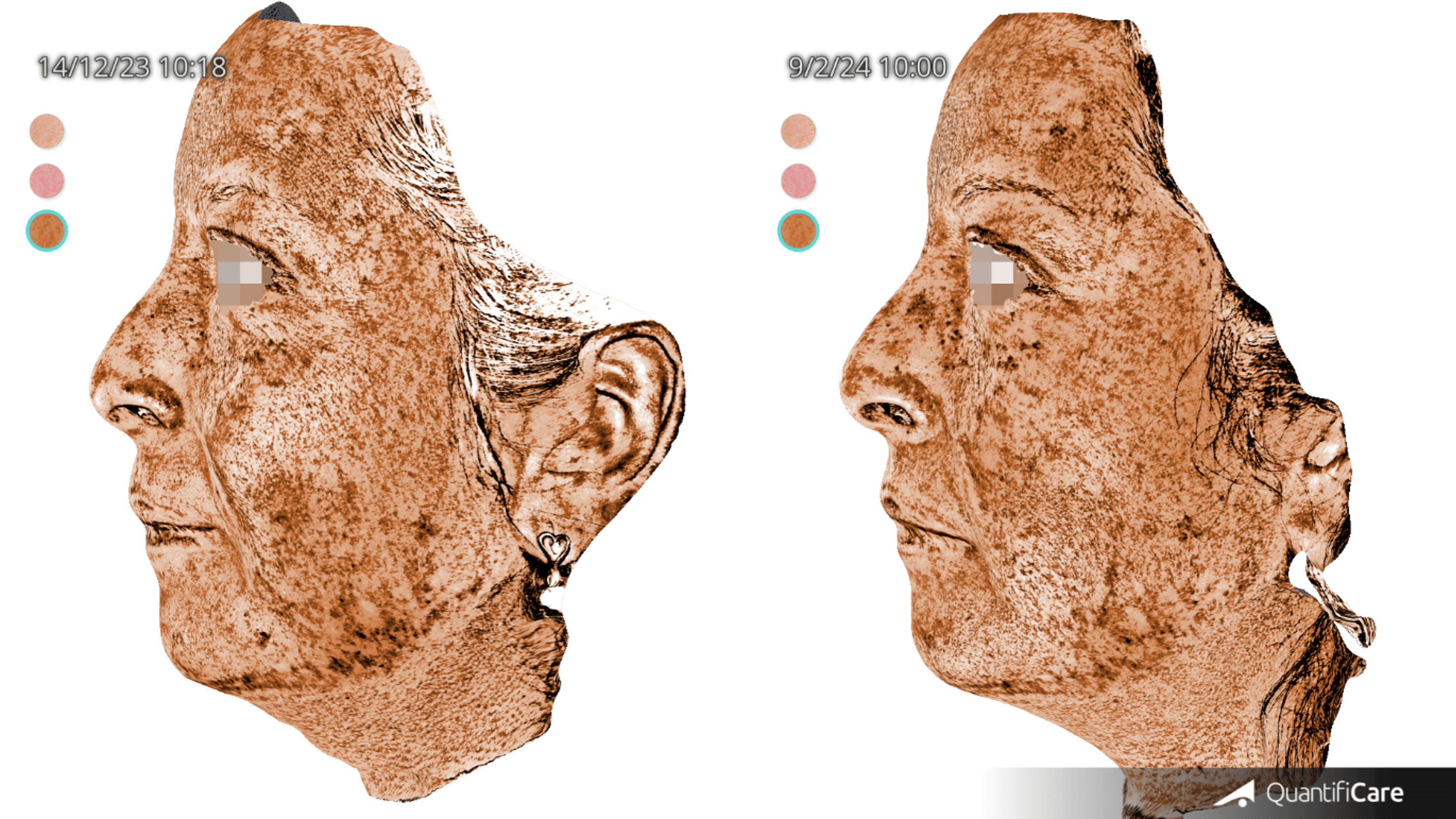 Resultado antes y después con INNO-EXOMA EXO-SKIN - Paciente 3, imagen 2