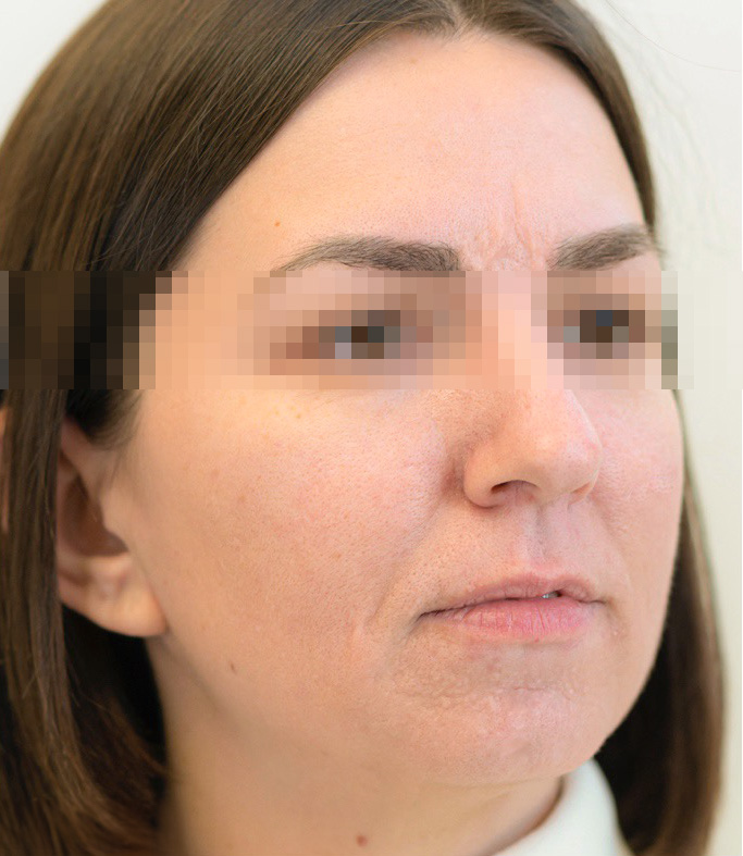 After treatment