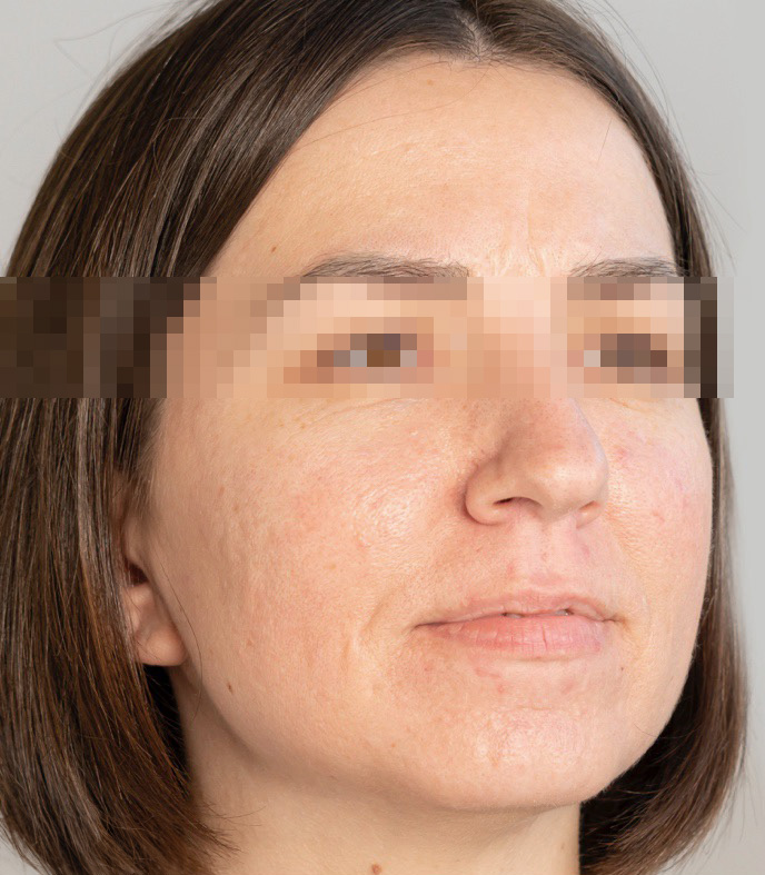 Before treatment