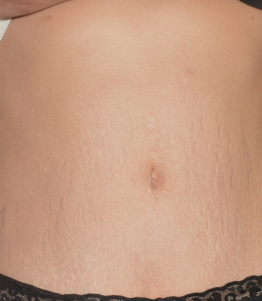 After treatment