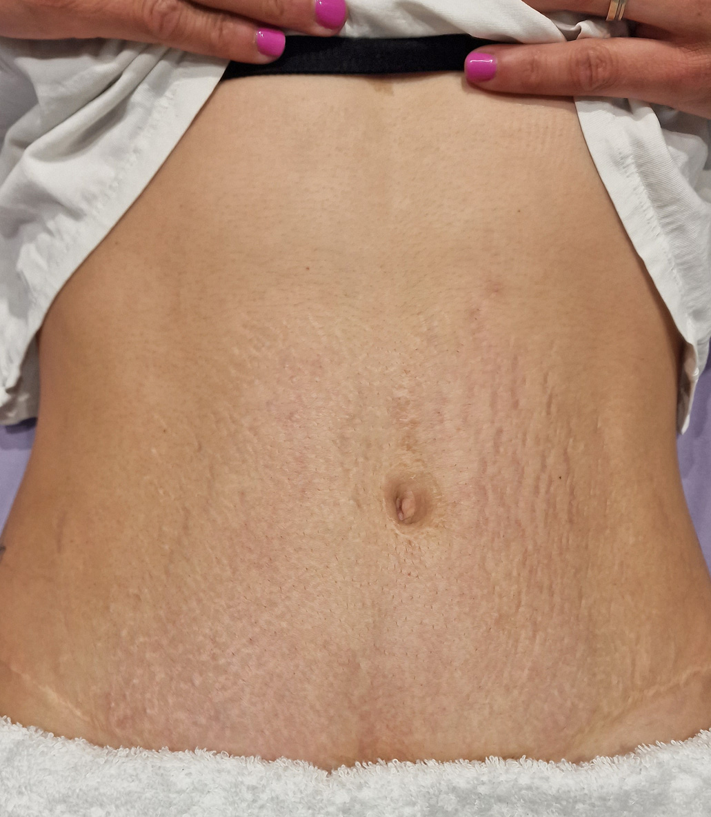 Before treatment