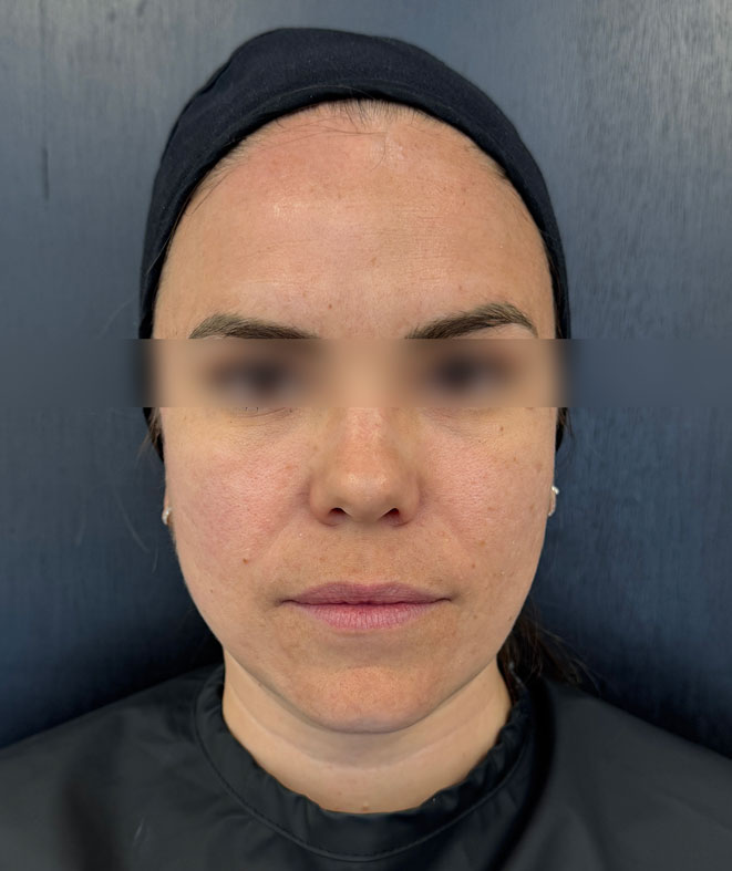 After treatment