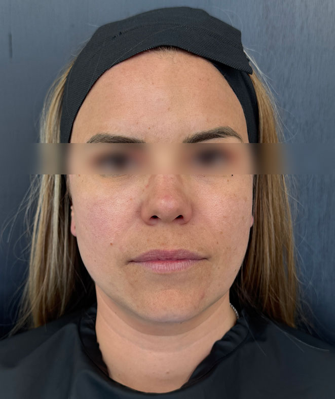 Before treatment