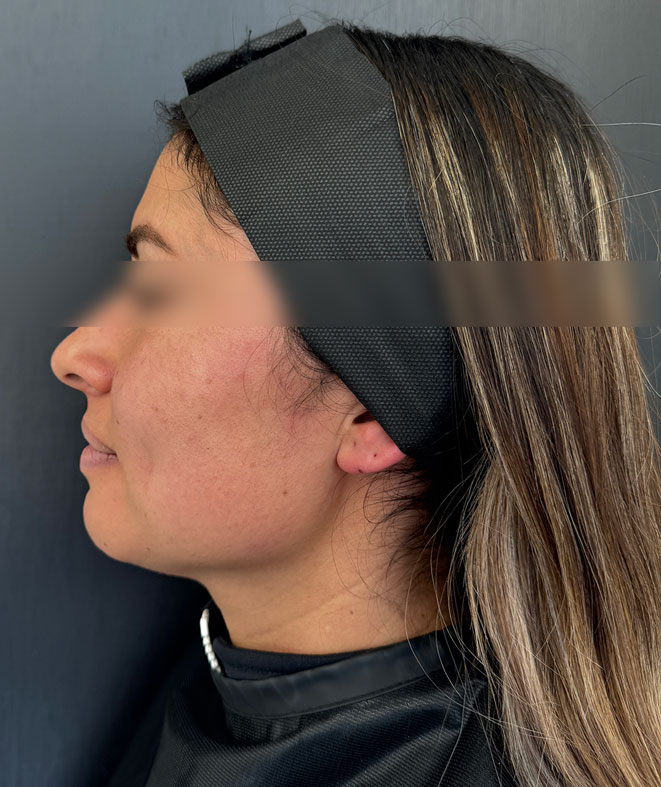After treatment