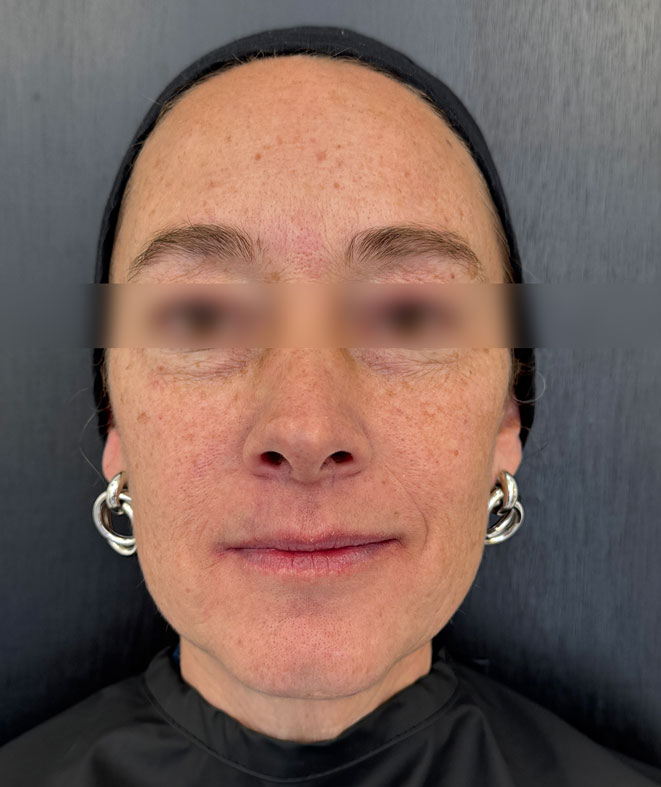 Before treatment