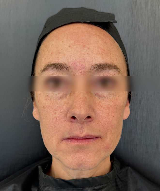 After treatment