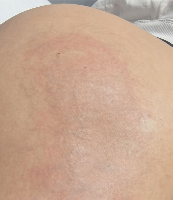 After treatment