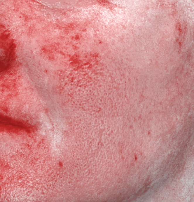 After treatment result 1
