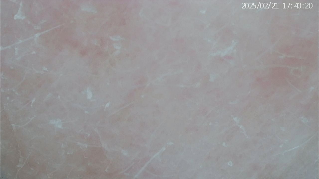 Representative skin surface before treatment