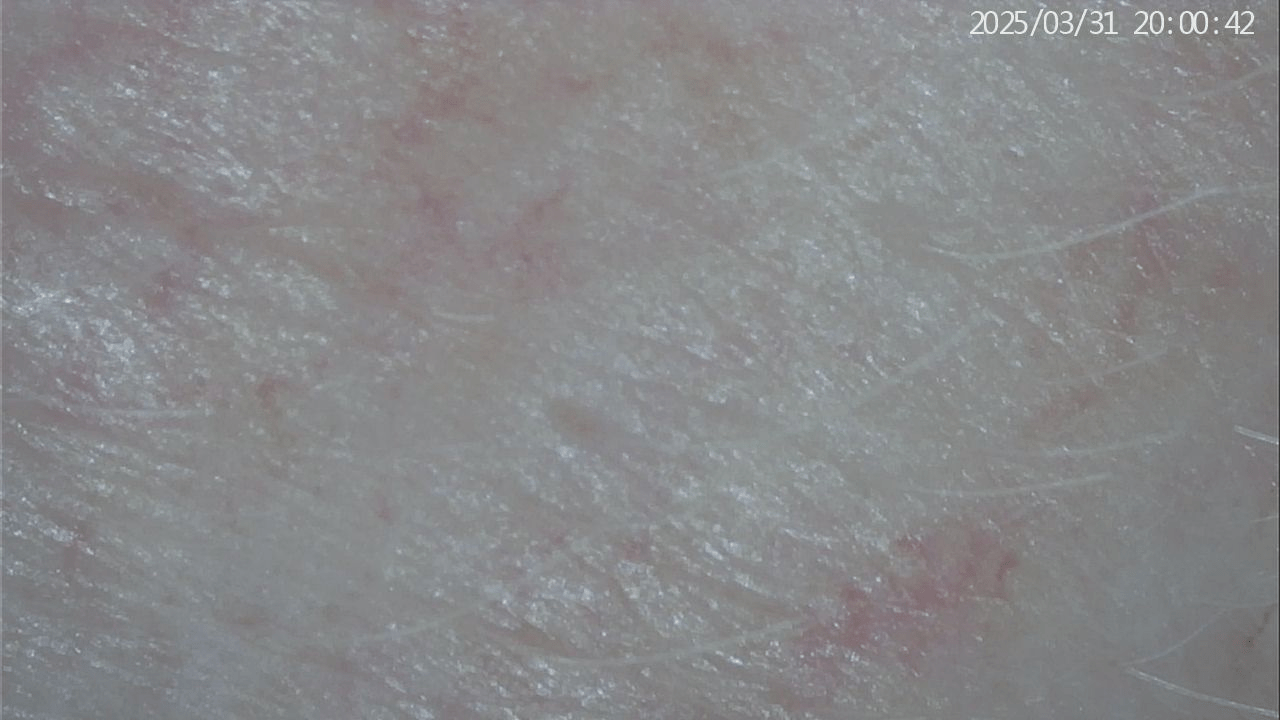 Representative skin surface after treatment