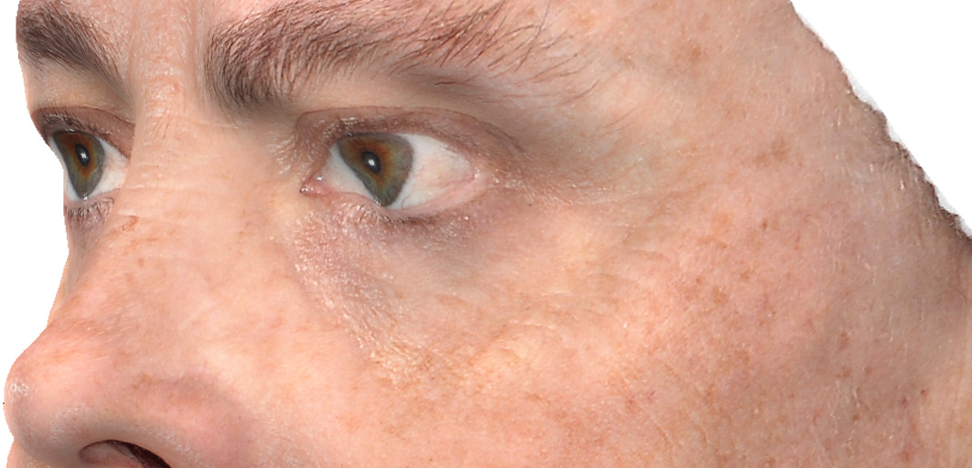 R-Eye Technique case 2 before treatment