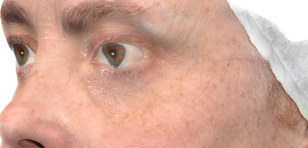 R-Eye Technique case 2 after treatment