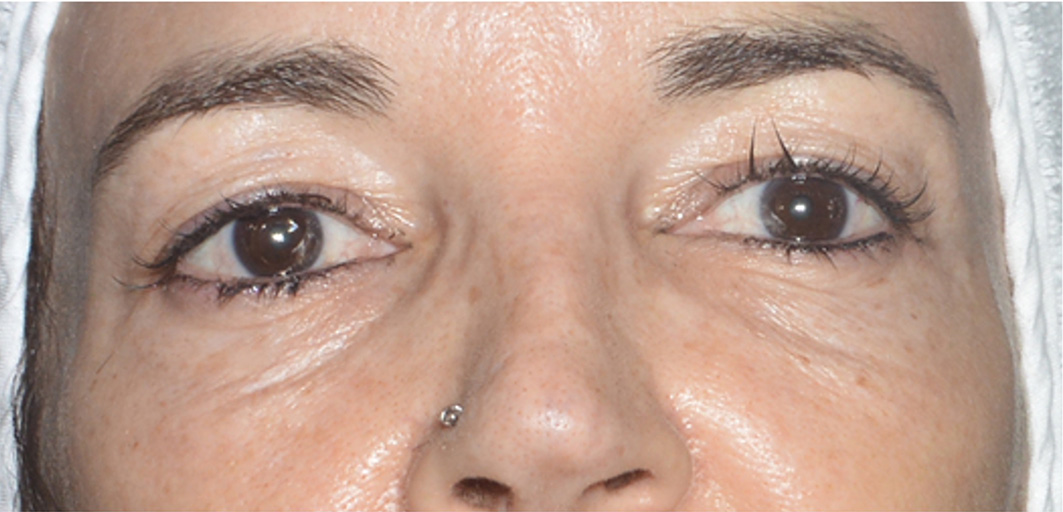 R-Eye Technique case 1 before treatment