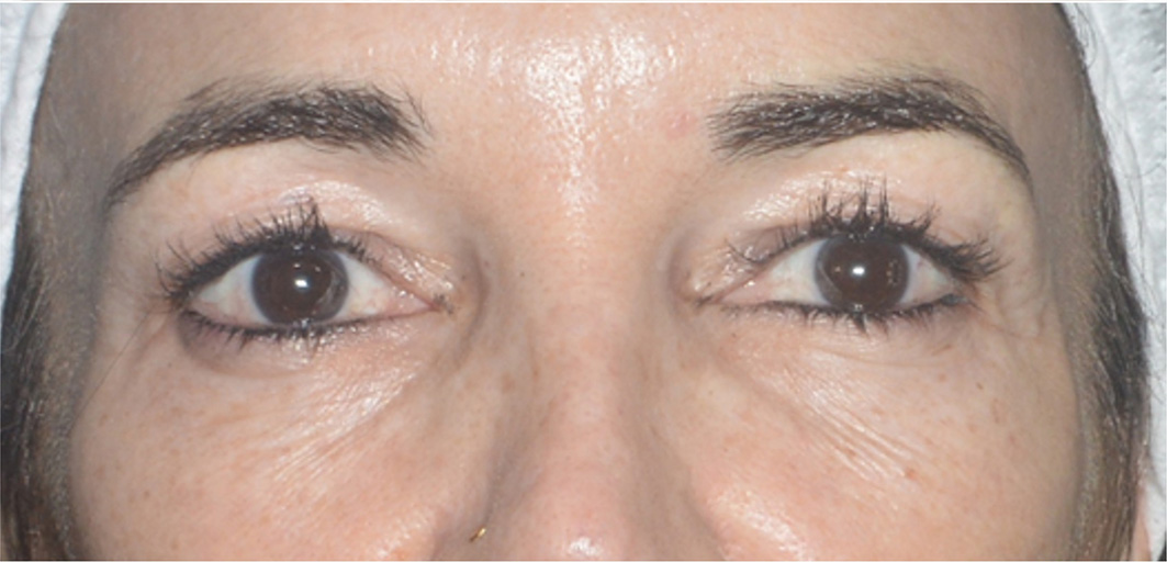 R-Eye Technique case 1 after treatment