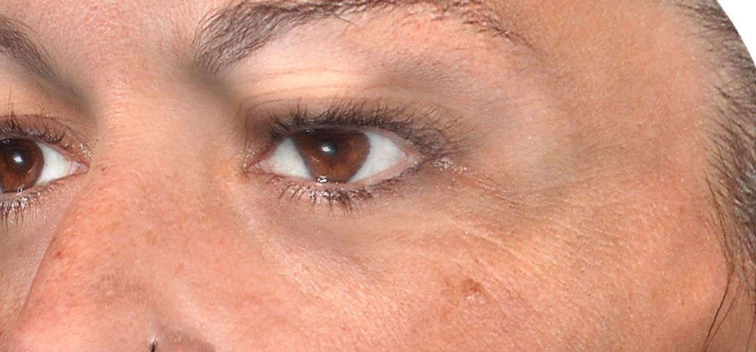 R-Eye Technique case 3 before treatment