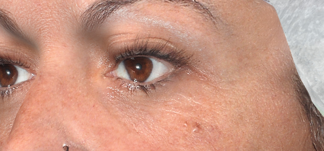 R-Eye Technique case 3 after treatment