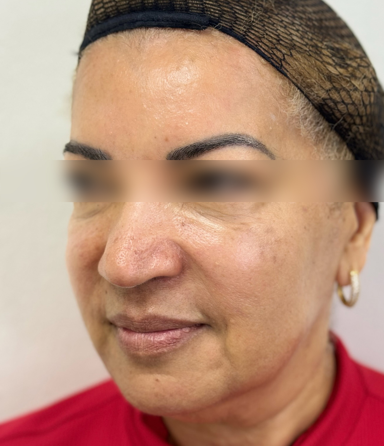 Triple R Technique result after treatment