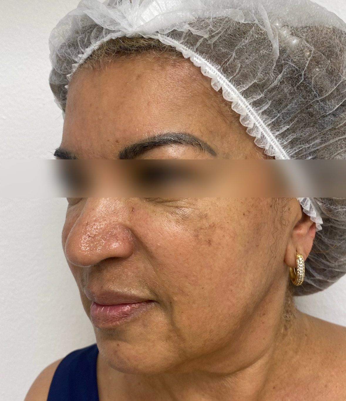 Triple R Technique result before treatment