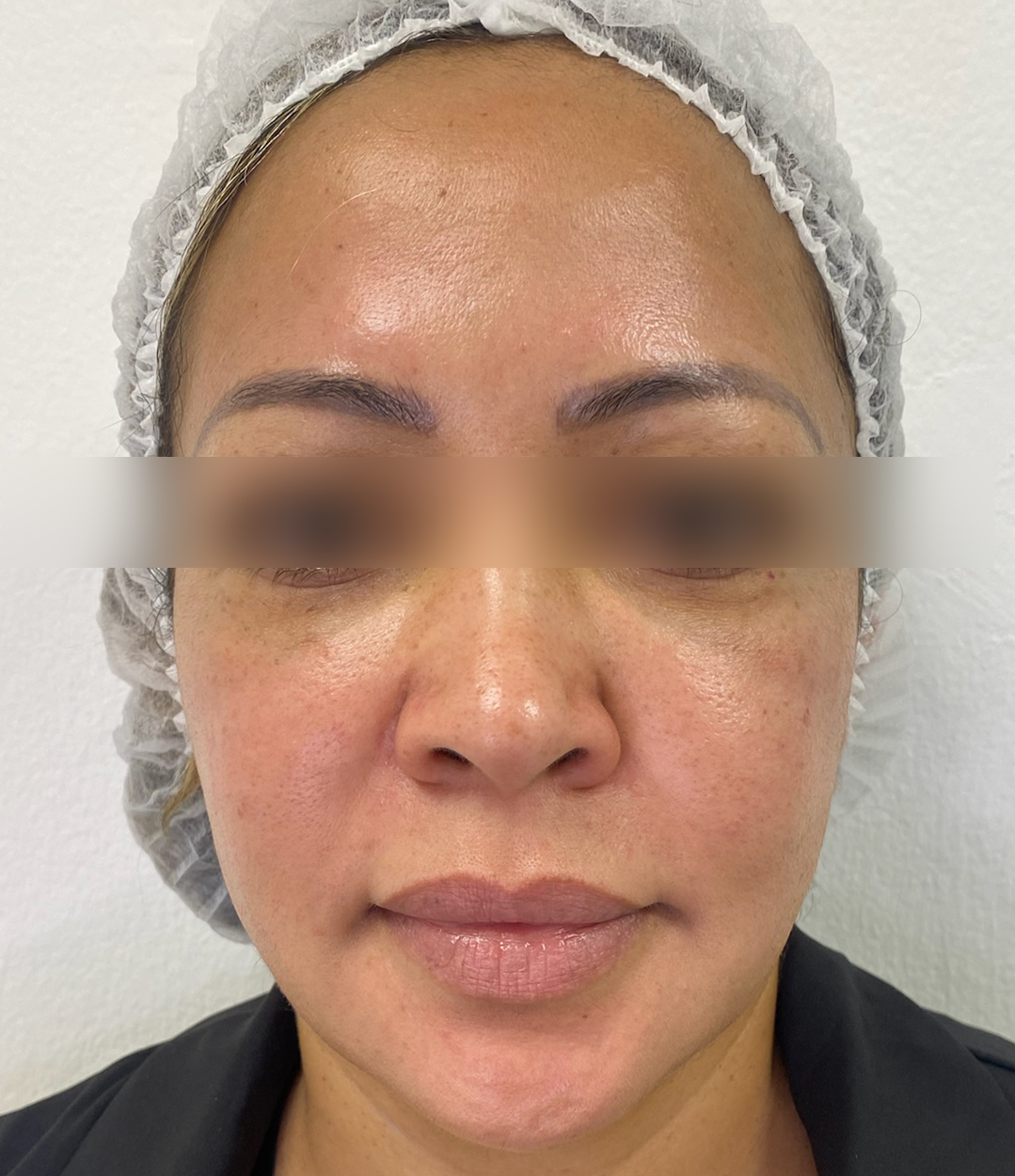 Triple R Technique result after treatment
