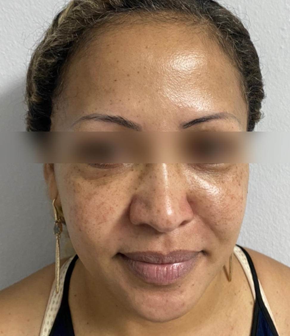 Triple R Technique result before treatment
