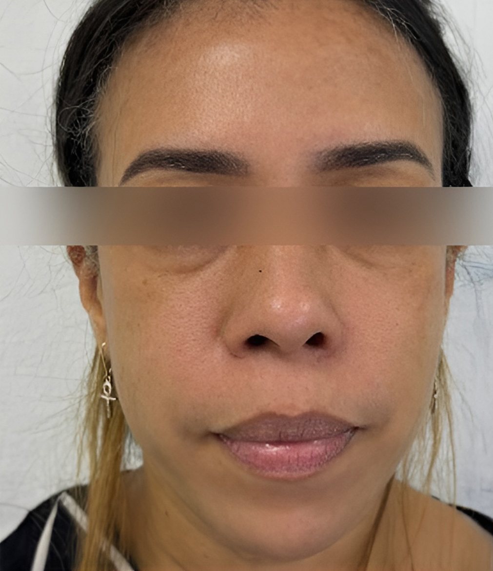 Triple R Technique result after treatment