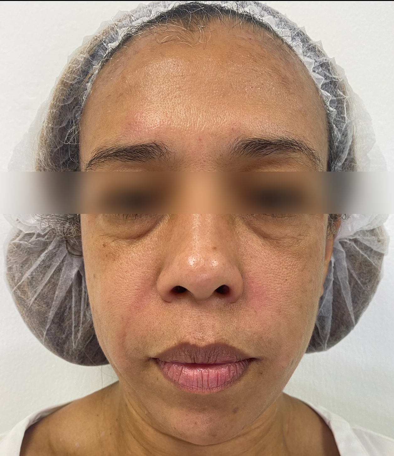 Triple R Technique result before treatment