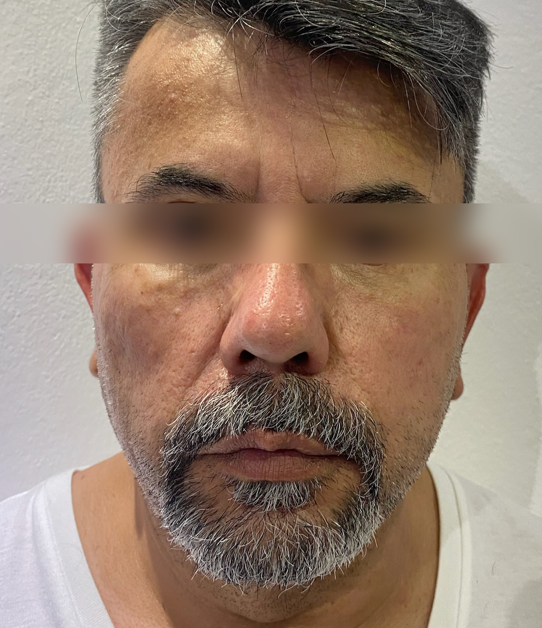 Triple R Technique result before treatment