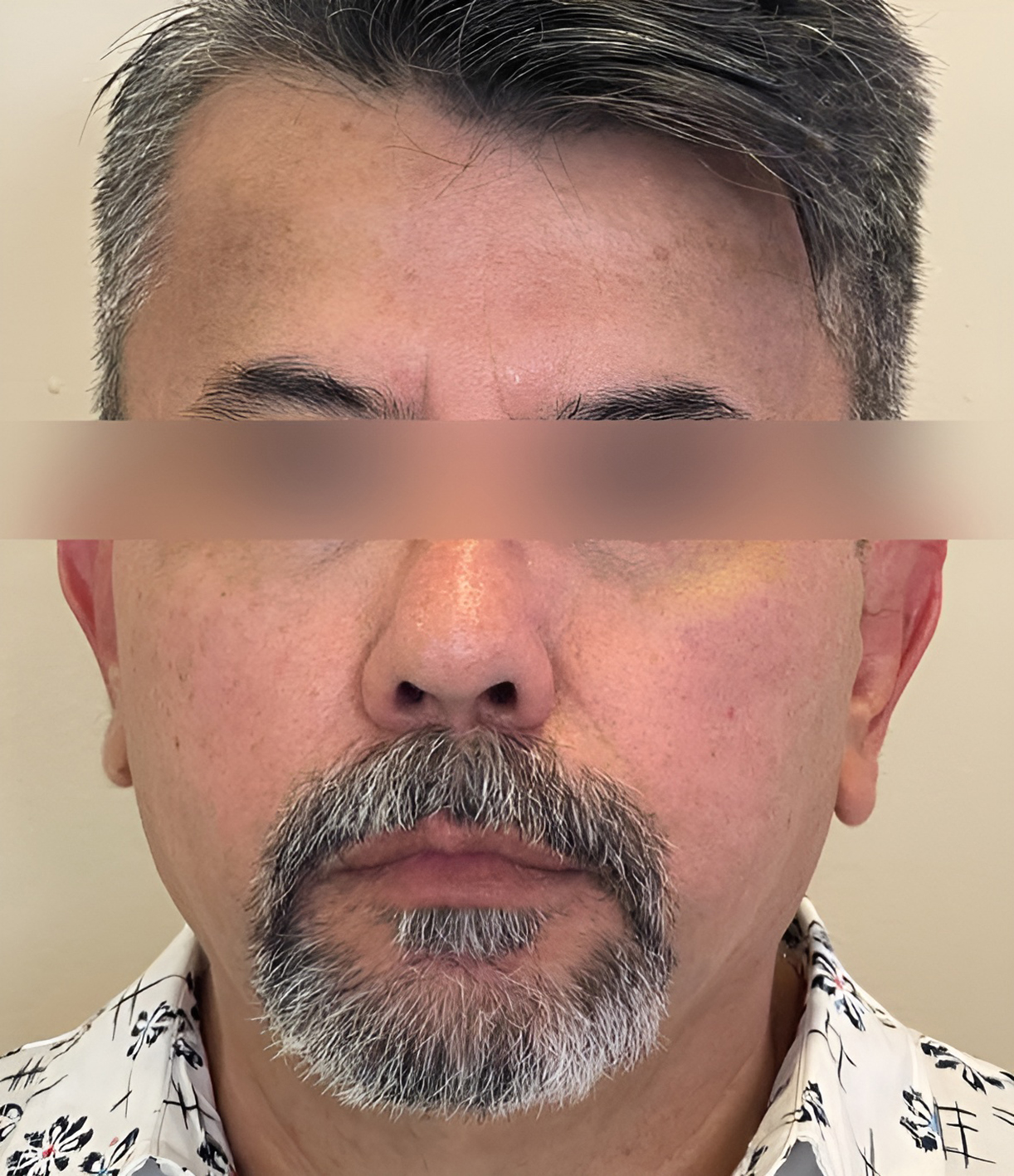 Triple R Technique result after treatment