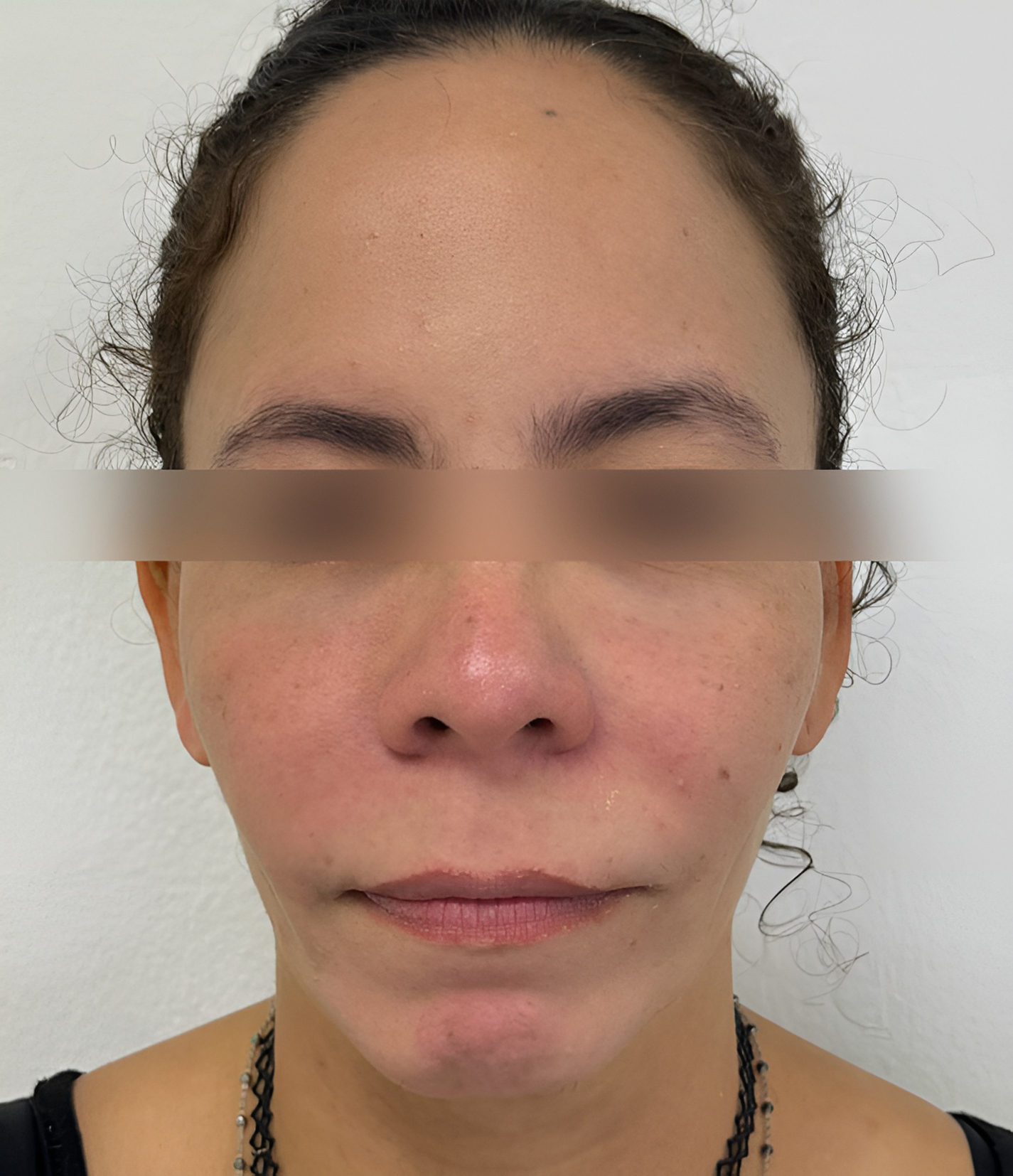 Triple R Technique result after treatment