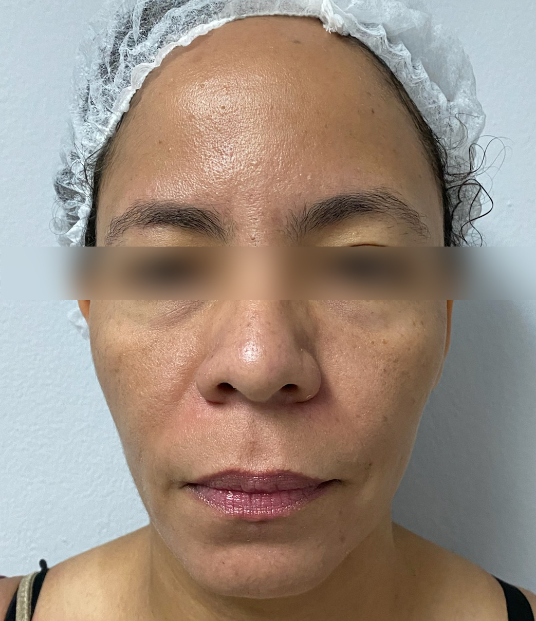 Triple R Technique result before treatment